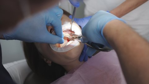Close-up of a dentist removing a patient's tooth. Wisdom tooth extraction in a dental clinic.