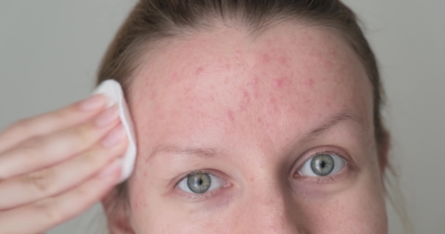 Close up of woman forehead with problematic skin and acne applying skin care product with cotton pad. | Shutterstock HD Video #1077673097