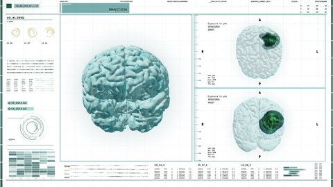 Innovative Software Proceeds With Patient Brain Diagnosis Scan. Patient Diagnosis Scan Results Displayed In Multiple Windows. Modern Medical Interface Finds Brain Tumor During Patient Diagnosis Scan