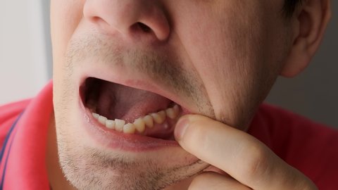 Man is showing tooth in mouth with a dental abscess fistula on gum, closeup view. Tooth with a temporary filling seal. Caries dental concept. Dental treatment of the internal parts of the tooth.