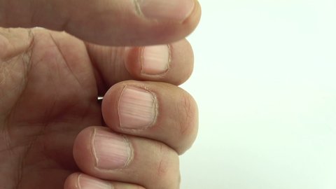 55 White Spots On Finger Nails Stock Video Footage - 4K and HD Video Clips  | Shutterstock