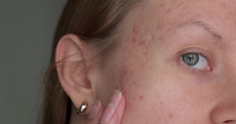 Woman touching post acne scars. Skin health. 