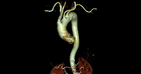 CTA thoracic aorta axial view for diagnosis aortic aneurysm.