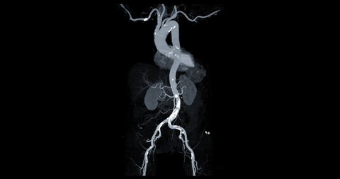 CTA whole aorta 3D MIP turn around on the screen for diagnosis aortic aneurysm.