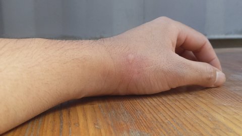 Rash on the back of the hand that was bitten by a mosquito.