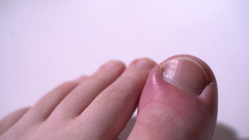 Swollen big toe on a white background. Inflammation of the periungual cushion of the big toe. Panaritia. Close-up | Shutterstock HD Video #1079198450