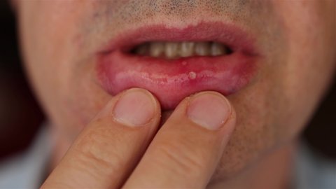 recurrent aphthous ulcers or canker sores, sore lip. Aphthous stomatitis, benign and non contagious mouth ulcers. Canker