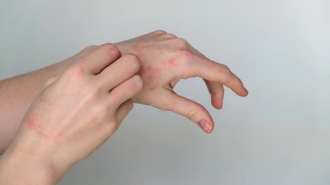 Women's hands with eczema itch and hurt. Girl scratches hands covered with red crusts of atopic dermatitis. Dermatological problems with hands.
