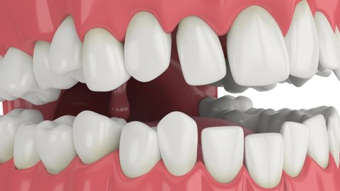 Teeth alignment by orthodontic metal braces isolated over white background