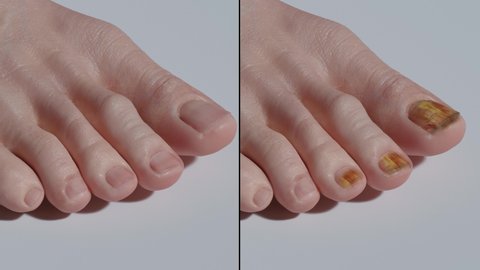 4K Animation Of Nail Fungus. Split Screen Of Healthy Nails And Fungus Nails.