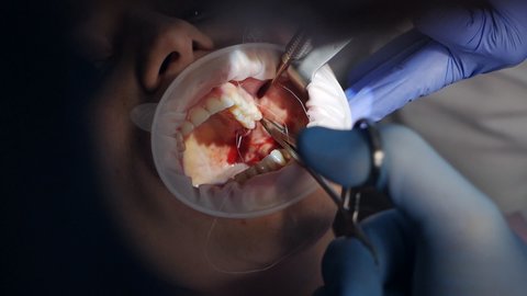 Stitching. Dental surgeon working with a patient in a modern dental clinic