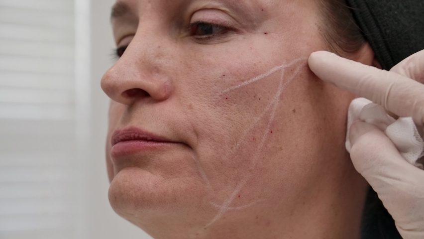 A thread lift is a type of procedure wherein temporary sutures are used to produce a subtle but visible lift in the skin. PDO Thread lift is non-surgical operation for sagging skin tissues. Royalty-Free Stock Footage #1079653346