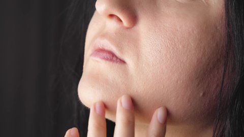 A woman with problematic skin and enlarged pores touches her face. The concept of enlarged, skin care. Close-up of a woman's face
