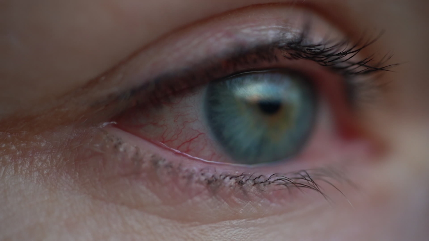 Close up of woman with irritated dry red eye or allergy without medical treatment. Female suffering from redness, inflamed and dilated capillaries. Conjunctivitis, keratitis, trauma concept. Royalty-Free Stock Footage #1079753876