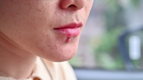 Footage of woman using tissue paper for cleaning and absorbing lymph from Herpes labialis occur on her lower lip. Herpes simplex virus is an infection that causes herpes.