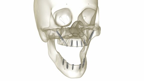 Maxillary and Mandibular prosthesis supported by zygomatic implants. Medically accurate 3D animation of human teeth and dentures