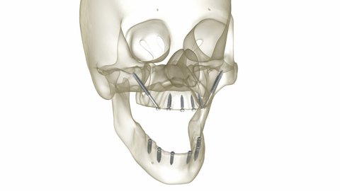 46 All On 4 Dental Implants Stock Video Footage - 4K and HD Video Clips | Shutterstock 46 All On 4 Dental Implants Stock Video Footage - 4K and HD Video Clips | Shutterstock