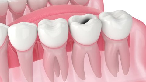 Tooth growth problems caused by the lack of space maintainer between teeth