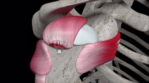 This 3d animation shows the shouder surgery with one anchor suture of the small crescent tear of the rotator cuff
