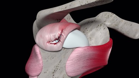 This 3d animation shows the shouder surgery with corner stitch suture of the l shaped tear of the rotator cuff