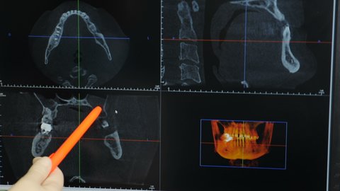 Dentist pointing At X-Ray image on computer display. Dental assistant taking closer look at human jaw on computer monitor and pointing at different areas. CT and MRI scanning. healthcare, medical and