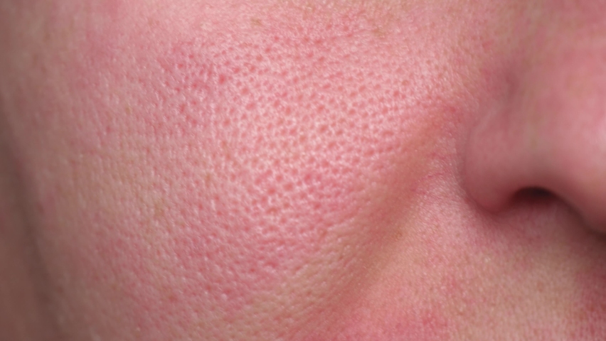 Macro enlarged pores. Problematic skin. Irritation on the face. | Shutterstock HD Video #1080894077