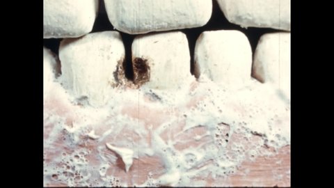 1950s: Image of teeth in mouth with cavities. Exterior of building. Sign: Miss Regent Nurse.