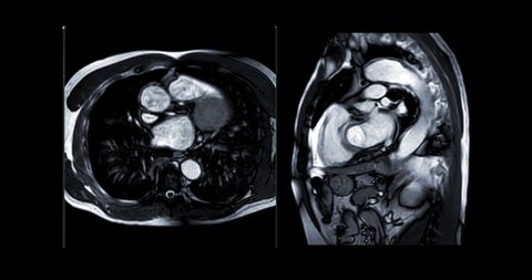 MRI heart or Cardiac MRI ( magnetic resonance imaging ) of heart showing heart beating for detecting heart disease.