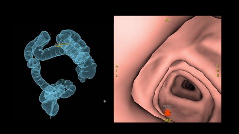 CT colonography 3D rendering image and 3D movie 4k file for screening colorectal cancer. Check up Screening cancer of colon.
