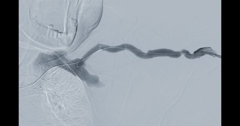 Percutaneous transluminal angioplasty or PTA of the arteries of the arm in brachial artery and cerebral ischemia
