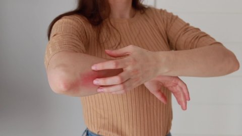 A young woman scratches the itching on her elbow with a reddening rash. Itching is caused by dermatitis (eczema), dry skin, burns, food  drug allergies, insect bites. Health care concept.