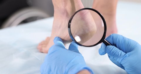 Podiatrist doctor examining cracks in patient heels with magnifying glass 4k movie