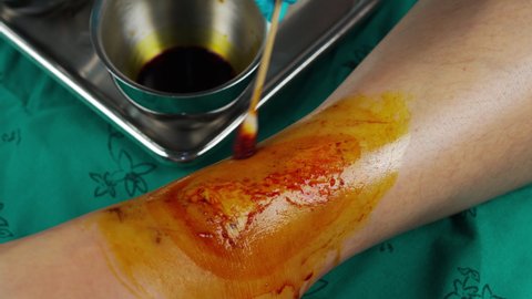 close up doctor cleaning wound on the leg by cotton bud and iodine tincture, Injuries from falling