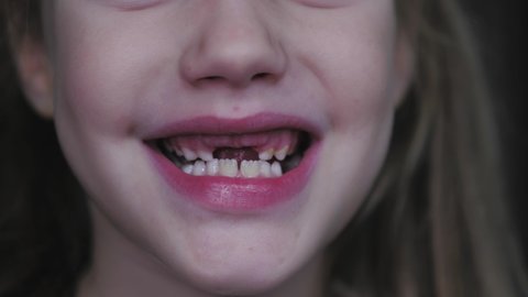 Close-up smile of a girl with lost milk teeth. Loss of deciduous teeth, replacement of permanent teeth. Children at dentistry.