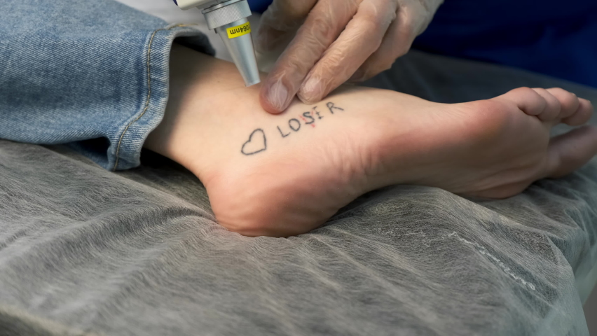 Laser removing of tattoo with words loser, lover and heart on woman's foot in red and black colours, closeup hands in gloves of doctor. Romantic tattoo symbol of youth love and disappointment in life. Royalty-Free Stock Footage #1081544753
