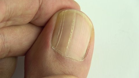 55 White Spots On Finger Nails Stock Video Footage - 4K and HD Video Clips | Shutterstock 55 White Spots On Finger Nails Stock Video Footage - 4K and HD Video Clips | Shutterstock