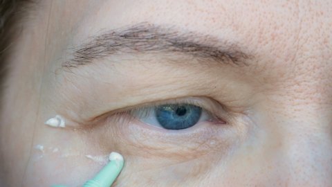 middle aged female's eye with drooping eyelid and cream cosmetic. Ptosis is a drooping of the upper eyelid, lazy eye. Cosmetology and facial concept, first wrinkles