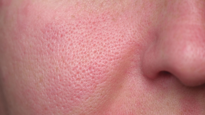 Macro skin texture, enlarged pores. Part of a woman's face. Problem skin, irritation. Irritation on the face. Royalty-Free Stock Footage #1081731434