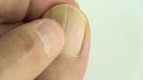 55 White Spots On Finger Nails Stock Video Footage - 4K and HD Video Clips | Shutterstock 55 White Spots On Finger Nails Stock Video Footage - 4K and HD Video Clips | Shutterstock