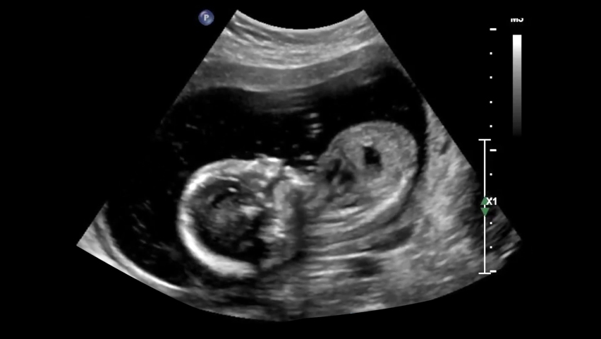 Ultrasound of baby body and spine. Human embryo is slightly moving his head on an ultrasound display.
12 weeks of life. Baby in mother's womb during sonography. | Shutterstock HD Video #1081949861