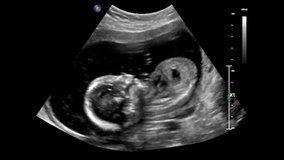 Ultrasound of baby body and spine. Human embryo is slightly moving his head on an ultrasound display.
12 weeks of life. Baby in mother's womb during sonography. - Powered by Shutterstock - Get 15% off with code: PIKWIZARD15