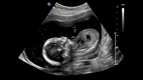 Ultrasound of baby body and spine. Human embryo is slightly moving his head on an ultrasound display.
12 weeks of life. Baby in mother's womb during sonography. Arkivvideo