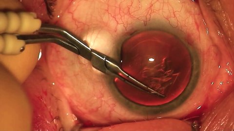 Laser vision correction. Eye lens implantation process. Macro footage of Eyes During Eye Ophthalmological Surgery.Eyelid speculum. Lasik treatment. Patient under sterile cover.