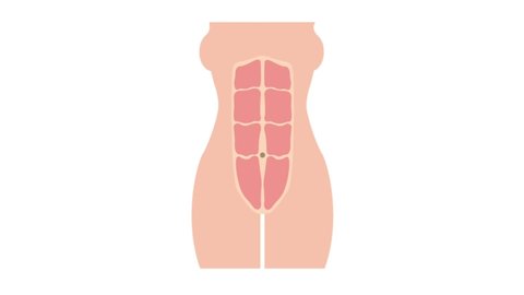 Formation of diastasis recti from normal toned abdomen muscles, also known as abdominal separation, common among pregnant women 