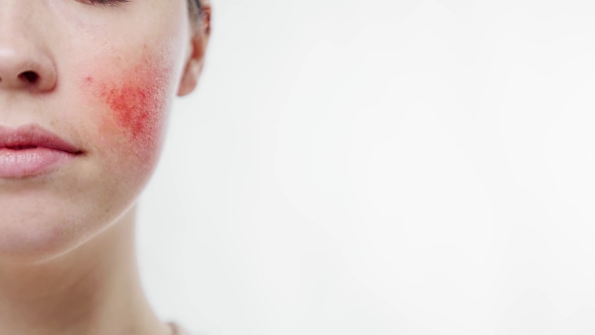 A woman's face with a red inflamed cheek close-up. A females hand presses a virtual button on the touchscreen. Close up. White background. The concept of rosacea and skin diseases
