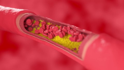 a blood clot clogs a vessel affected by a cholesterol plaque cross section view. High quality FullHD footage