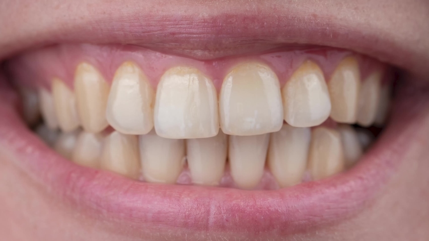 Close-up of a woman's smile before and after teeth whitening. | Shutterstock HD Video #1082263229