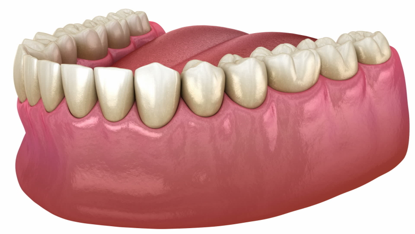 Gum recession process. Medically accurate 3D animation  | Shutterstock HD Video #1082410729