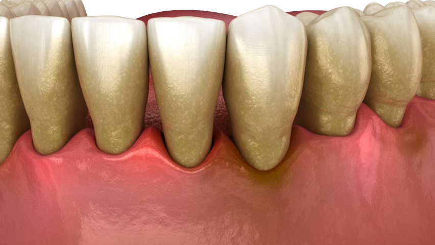 Gum recession process. Medically accurate 3D animation  | Shutterstock HD Video #1082410729