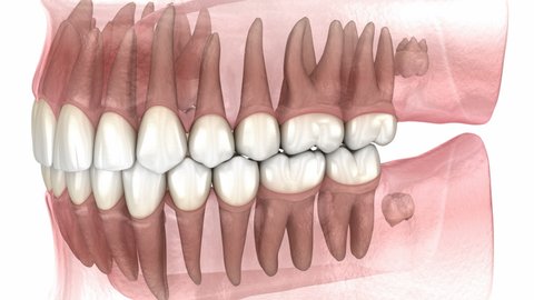 Wisdom tooth and gum inflammation. Medically accurate tooth 3D animation 
